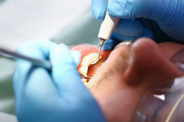 Best Emergency Dentist for Lost Fillings or Crowns in Seven Corners, VA